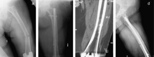 Caso clínico n.° 4. Fractura atípica medio-diafisaria de fémur en paciente con una ATR: a) radiografía postfractura; b) radiografía postenclavado endomedular; c) fractura de estrés monocortical, y d) retardo de consolidación.
