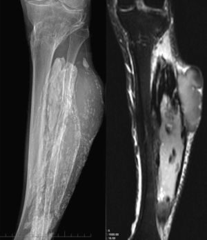 Radiografía AP de pierna (derecha) y cortes coronales de RM en secuencias potenciadas en T1 (central) y T2 (izquierda) en los que se identifica las calcificaciones de características típicas, y el componente de partes blandas, que se detecta mejor en la RM, de aspecto quístico complejo. Se observa también la fractura consolidada de la metáfisis proximal de la tibia.