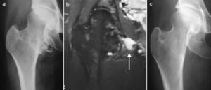 Caso 5 antes de la cirugía, con su aspecto radiográfico (a) y en RM, con la hiperseñal de la bursitis iliopsoas (flecha) (b). Control radiográfico tres años después de la resección en bloque (c).