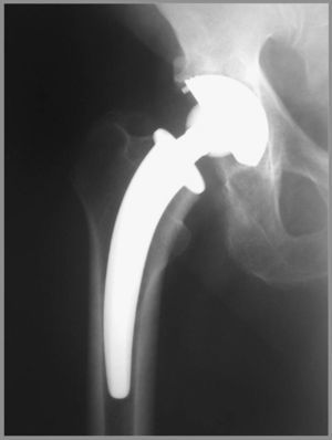 Vástago CFP. Se apoya en el cuello femoral y su extremo se aloja en la diáfisis proximal.