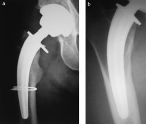 a) Fractura intraoperatoria de la cortical externa de un implante CFP y reabsorción secundaria del cuello (Falez). b) Remodelación con engrosamiento de la cortical diafisaria.
