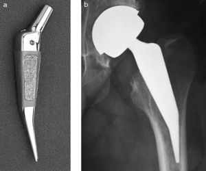 Mayo conservative. a) Vástago en doble cuña, con revestimiento proximal. b) Se aloja en las metáfisis, respetando el cuello; la cuña proximal sigue el perfil medial del cuello femoral, la prolongación distal se apoya en la cortical externa.
