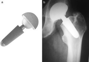 a) Silent, prótesis cefálica apoyada en el cuello. Admite cualquier cabeza sobre un cono 12/14. b) Vástago Silent osteointegrado.