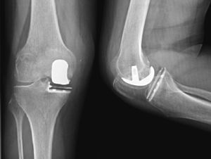 Radiografía simple anteroposterior y lateral de rodilla, tras artroplastia unicompartimental del compartimento interno, mediante implante solamente de polietileno.