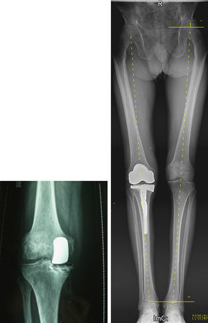 Radiografía simple anteroposterior de rodilla y tele-radiografía que muestran aflojamiento aséptico precoz del componente tibial por malposición y la necesidad de recambio por una prótesis total de rodilla con vástago y suplemento tibial.
