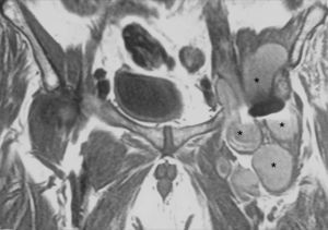 Resonancia magnética nuclear (corte coronal de pelvis ponderado en T1). Masa quística de 15×8cm polilobulada (*), de contenido heterogéneo con focos hiperintensos, entre la prótesis total de cadera (artefacto negro central) y el plano profundo del músculo ilíaco, siguiendo el eje de la arteria ilíaca y femoral.