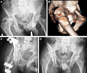 A-B) Fractura de pared posterior con luxación coxofemoral asociada de 1 mes de evolución. C) Radiografía (Rx) obturatriz postquirúrgica. A la osteosíntesis se asoció fijador externo. D) Rx anteroposterior pelvis a los 20 meses postquirúrgicos, no coxartrosis, osificaciones heterotópicas Brooker II.