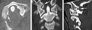 Tomografía axial computarizada cervical del paciente 1: fractura impactada del cóndilo occipital derecho y fractura C1.