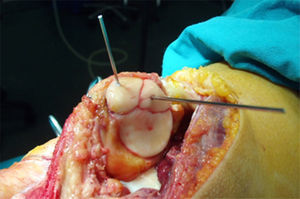 Imagen de la lesión patelar osteocondral medial en rodilla derecha. Intervención quirúrgica, reconstrucción con tornillos reabsorbibles.