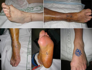 Distintas imágenes de marcas realizadas por los pacientes.