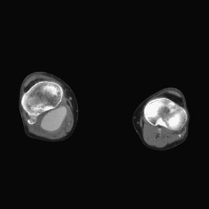 Tomografía computarizada de corte axial. Imagen en fosa poplítea de aspecto compatible con pseudoaneurisma.