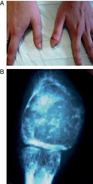 A) Aspecto clínico del pulgar. B) Imagen radiológica de la lesión tumoral.