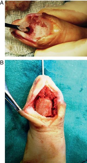 Técnica quirúrgica reconstructiva. A) Curetaje cavidad tumoral. B) Relleno cavitario con chips esponjosos e injerto corticoesponjoso estructural. Estabilización con aguja de Kirschner axial.