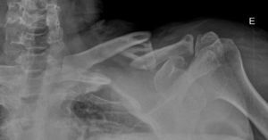 Fractura conminuta diafisaria de clavícula.