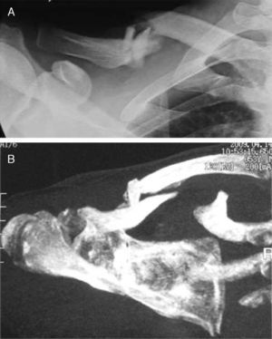 Fractura en tercer fragmento en cuña de tercio medio de clavícula. A) Proyección radiológica; B) tomografía computarizada.