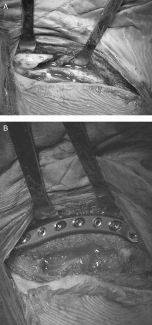 Fractura de clavícula. A) Intervención quirúrgica apreciándose la conminución del foco; B) fijación interna con placa anatómica superior e injerto óseo.