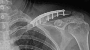 Proyección radiológica apreciando la fijación interna y la consolidación de la fractura.
