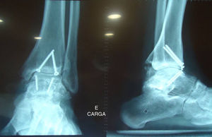 Radiografía en carga del tobillo izquierdo 15 meses después de la intervención.