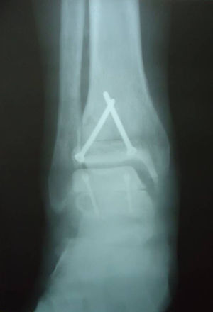 Radiografía del tobillo derecho tres meses después de la intervención.