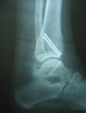 Radiografía del tobillo derecho tres meses después de la intervención.