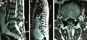 Imágenes sagitales (A y B) y axial (C) en T2 que muestran el fragmento de disco secuestrado a nivel epidural posterior de L3-L4. (B) Importante globo vesical.