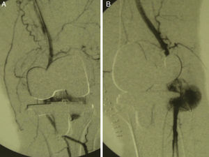 Arteriografía de extremidad inferior, donde se observa el pseudoanerisma de la arteria poplítea. A) Proyección anteroposterior. B) Proyección oblicua.