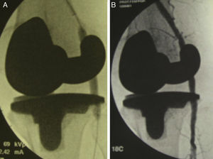 Colocación del stent dentro de la arteria poplítea (A) y comprobación arteriográfica de la permeabilidad de la misma (B).