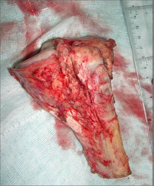 Osteosarcoma parostal tibia proximal. Exéresis del tumor.