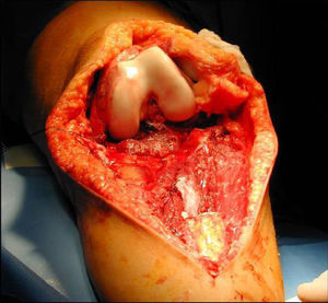 Defecto óseo creado tras la resección tumoral.