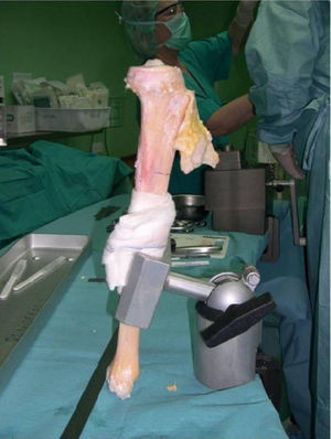 Aloinjerto óseo estructural tibia completo. Tallado del aloinjerto y enfundado en prótesis con exposición de aparato extensor.