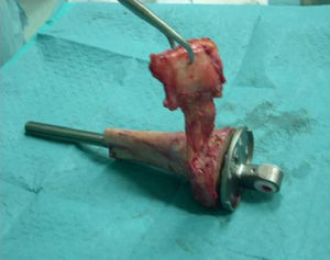 Aloinjerto óseo estructural tibia completo. Tallado del aloinjerto y enfundado en prótesis con exposición de aparato extensor.