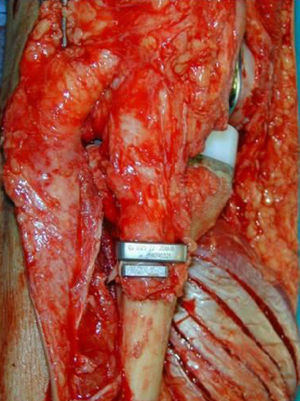 Implantación del aloinjerto con reinserción del aparato extensor. Imagen radiológica con consolidación completa a los 24 meses.