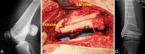 A) Osteosarcoma de superficie. B) Reconstrucción con aloinjerto intercalar hemicortical. C) Control radiográfico de la síntesis del aloinjerto.