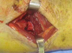 Con el periostótomo identificamos el trazo de fractura. El maléolo posterior está generalmente desplazado hacia lateral y proximal.