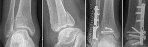 El abordaje posterolateral permite el uso de una única incisión para abordar tanto la fractura del peroné como el fragmento posterior articular de la tibia, realizando una reducción directa y anatómica de la superficie articular.