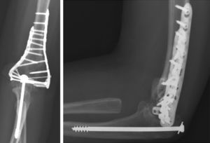 A la izquierda radiografía anteroposterior y a la derecha radiografía lateral a los 2 años de evolución.