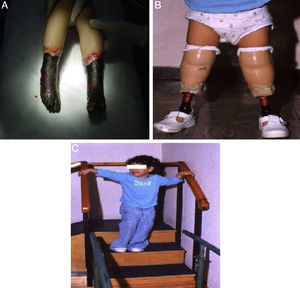 A) Necrosis de ambos pies con patrón de calcetín bien delimitado. B) La paciente con prótesis de ambulación en ambos pies. C) La paciente rehabilitando a las 2 semanas de la intervención.