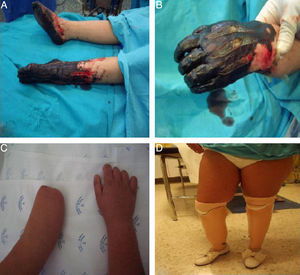 A y B) Necrosis de ambos pies y mano izquierda. C) Muñones de amputación mano izquierda y dedos mano derecha a los 3 años de la intervención. D) La paciente con prótesis de ambulación en ambas piernas a los 3 años de la intervención.