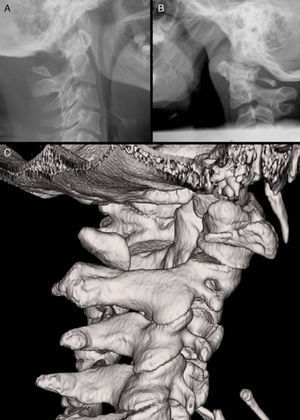A) Radiografía lateral del caso 1. B) Radiografía lateral del caso 2, apreciándose vestigio del arco derecho. C) Imagen 3D del TAC del caso 1.