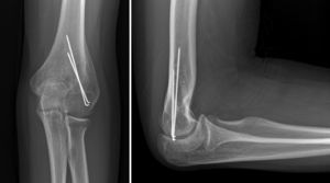 Radiografía a los 13 años de seguimiento del paciente en el no se pudo llevar a cabo la extracción de material de osteosíntesis, ante las dificultades encontradas durante la cirugía y que desaconsejaron su extracción.