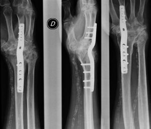 Radiografía 1 año posquirúrgica: artrodesis instrumentada muñeca.