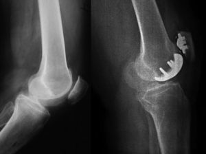 artroplastia femoro-patelar izquierda con prótesis femoropatelar LCS (Depuy, Warsaw IN).