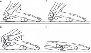 Mecanismo lesional del síndrome de Fenton (extraído del artículo de Stein et al.14, con permiso de la editorial JBJS). A) Posición de la muñeca en hiperextensión en el momento del impacto. Obsérvese que el hueso grande se sitúa a 90° con respecto al radio. B) El margen posterior del radio fractura el hueso grande. C) Fractura del escafoides y rotación del polo proximal del hueso grande a 90°. D) A medida que la muñeca vuelve a la posición neutra, el polo proximal del hueso grande continúa rotando hasta llegar a los 180°.