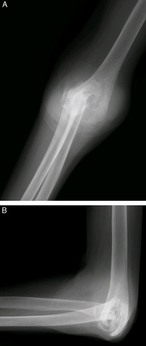 Radiografía preoperatoria de una paciente con artritis reumatoide avanzada y elevado grado de destrucción articular. A) Anteroposterior. B) Lateral.