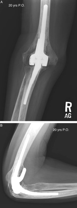 Radiografias anteroposterior (A) y lateral (B) 20 años tras la implantación de una prótesis de codo por artritis reumatoide.