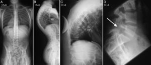 Telerradiografías de columna de un paciente de 17 años y 6 meses de edad con enfermedad de Scheuermann (fig. 1). La proyección posteroanterior (A) descarta la presencia de una escoliosis asociada, y la proyección lateral (B) demuestra la presencia de una cifosis torácica de 95°. Radiografía lateral en decúbito supino de la columna torácica (C) con el paciente en hiperextensión sobre una cuña o pibote que demuestra una corrección de la cifosis torácica hasta los 70°. Proyección lateral de la columna lumbosacra (D) que revela la presencia de una espondilolisis ístmica asociada.