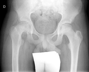 Radiografía A-P de pelvis de un adolescente de 12 años con ECF. Se aprecia una doble densidad en la metáfisis producida por la silueta de la cabeza femoral.