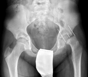 Radiografía A-P de pelvis con el porcentaje de desplazamiento de la epífisis sobre la anchura de la metáfisis.