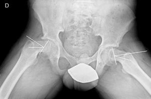 Radiografía axial de ambas caderas. Epifisiolisis de 36° en cadera derecha y 27° en cadera izquierda.