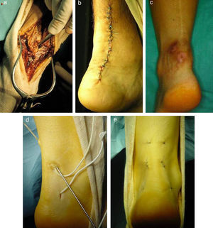 Reparación de la rotura del tendón de Aquiles: Abierta (a, b y c) (obsérvense las alteraciones tróficas en la cicatriz); mínimamente invasiva (d y e).